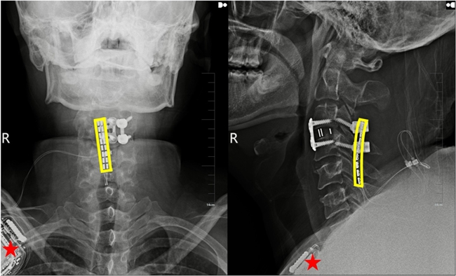 植入術后X線顯示，黃色方框為電極位置，星號為皮下脈沖發射器位置。
