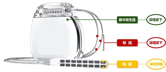 脊髓电刺激器植入部分示意图。